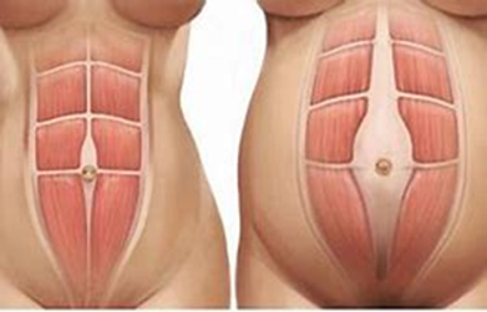 PoliambulatoriArcade_Fisioterapia_Donna_Diastasi_Addominale_01